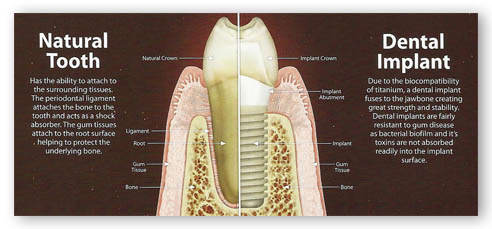 doğal diş ve implant karşılaştırması