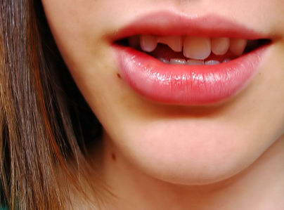 Diş Kırılması Nasıl Tedavi Edilir? Bonding